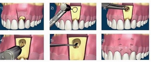 ✅Apicectomía guía completa 11 Clínica Dental en Molina de Segura apicectomia