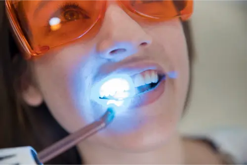 Blanqueamiento Dental con Láser: ¿Es seguro? 11 Clínica Dental en Molina de Segura blanqueamiento con laser dental