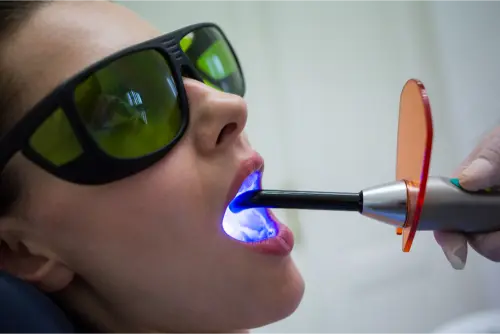 Blanqueamiento Dental con Láser: ¿Es seguro? 12 Clínica Dental en Molina de Segura blanqueamiento con laser dientes