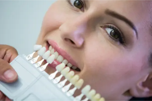 ✅Blanquear las carillas de composite en casa 11 Clínica Dental en Molina de Segura blanqueamiento con carillas como quitar carillas de resina y blanqueamiento carillas composite en clinica dentalmax