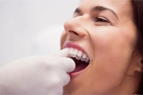 Invisalign: Revolucionando la Ortodoncia Invisible 13 Clínica Dental en Molina de Segura precio invisalign lite