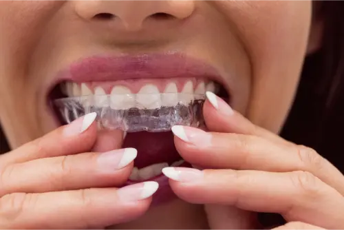 Invisalign: Revolucionando la Ortodoncia Invisible 11 Clínica Dental en Molina de Segura invisalign dientes