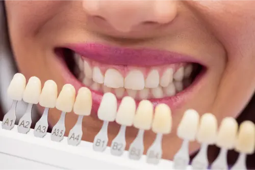 ✅Blanquear las carillas de composite en casa 16 Clínica Dental en Molina de Segura las carillas se pueden blanquear , como blanquear los dientes de resina o como blanquear una carilla de resina