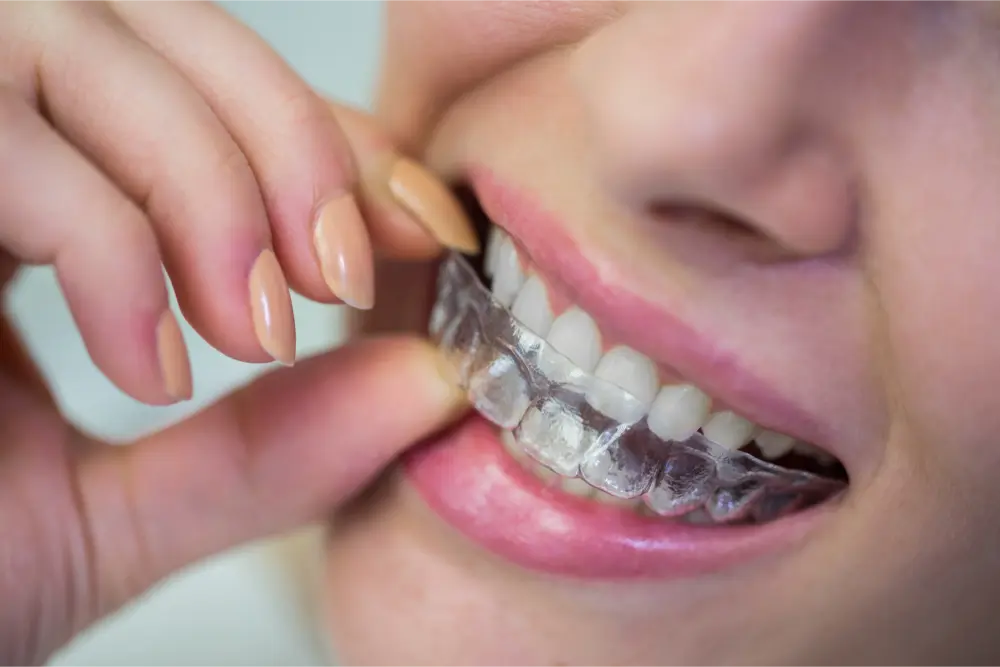 Cómo limpiar la férula dental: pasos y consejos para una limpieza adecuada 8 Clínica Dental en Molina de Segura como desinfectar ferula de descarga