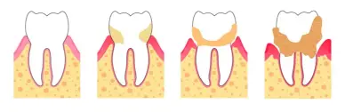 Sarro en los dientes: Cómo combatirlo y mantener una sonrisa saludable 2 Clínica Dental en Molina de Segura sarro en los dientes