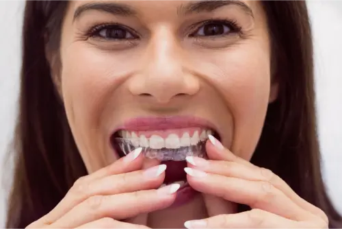 Cómo limpiar la férula dental: pasos y consejos para una limpieza adecuada 9 Clínica Dental en Molina de Segura como lavar ferula de descarga